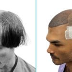 Best Hair Transplant Clinic in Kolkata
