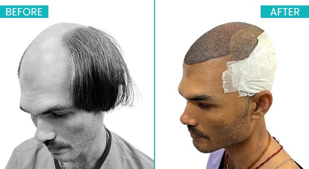 Best Hair Transplant Clinic in Kolkata