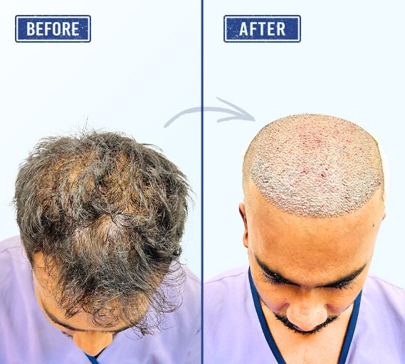 Hair transplant