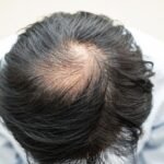 FUE vs FUT Hair Transplant: Which One is Right for You?