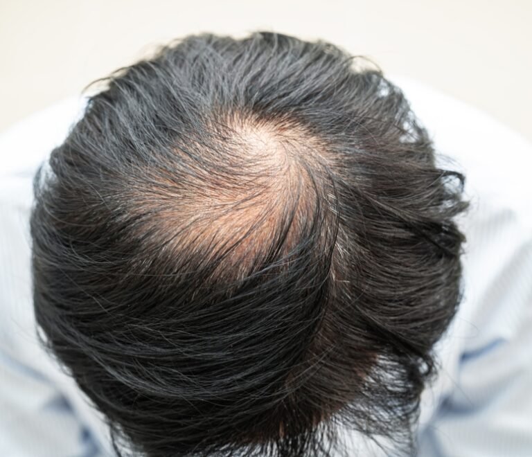 FUE vs FUT Hair Transplant: Which One is Right for You?