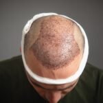 Top 7 Questions to Ask Before Getting a Hair Transplant