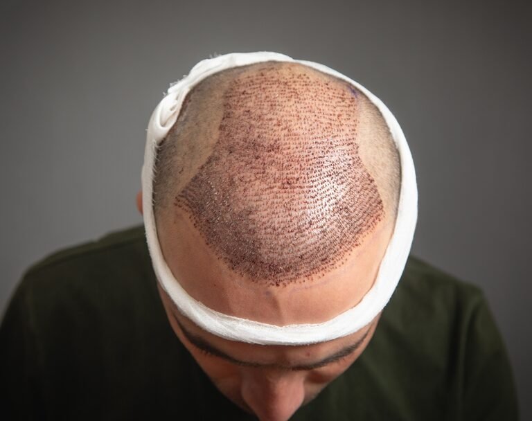 Top 7 Questions to Ask Before Getting a Hair Transplant